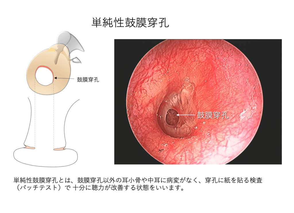 鼓膜の穴の手術的治療法について 大阪府豊中市細田耳鼻科